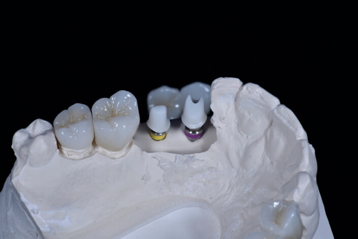 Implant crowns and porcelain crowns