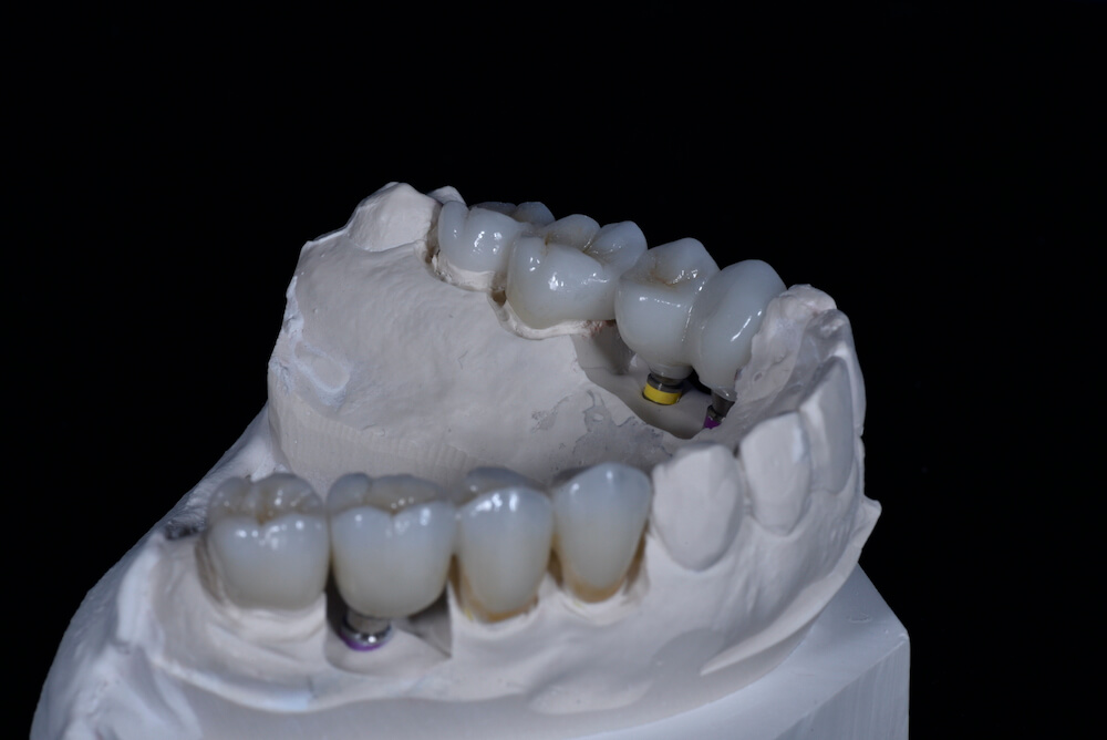 Implant crowns and veneer onlay made by master ceramist