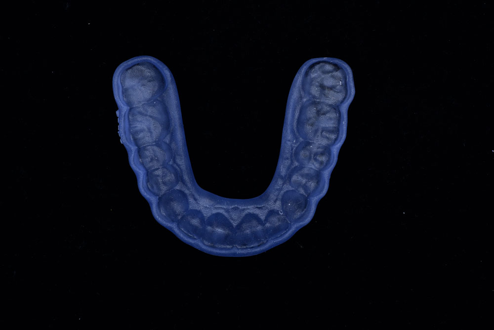 Lower veneers and crowns and onlays